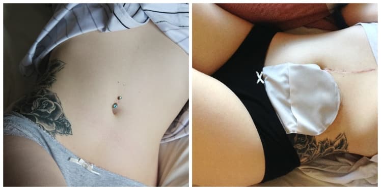 Living with a stoma bag isn’t miserable – it gives you a new lease of life
