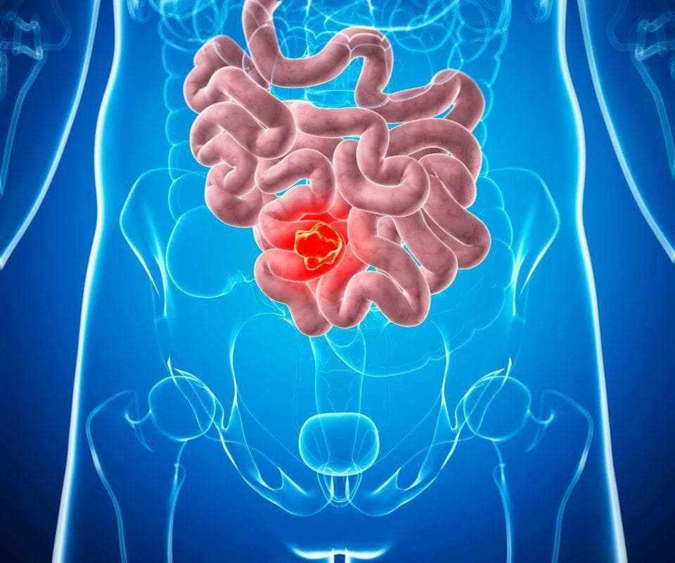 Bowel Symptoms Often Ignored